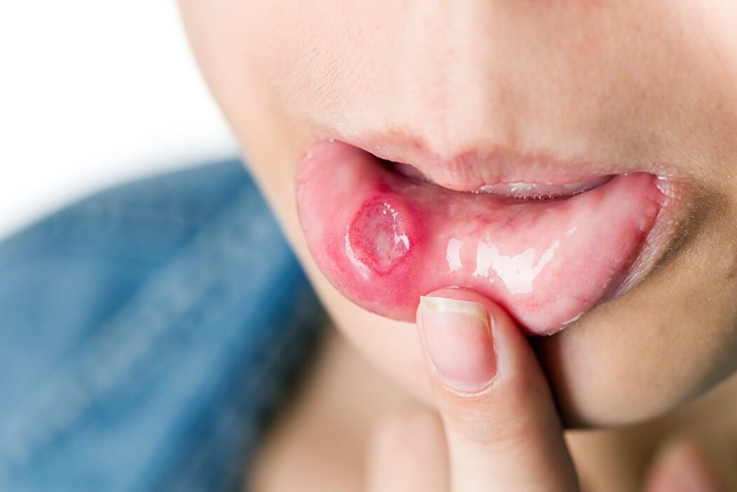 입안에 생긴 구내염