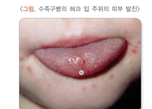 혀&middot;손발에 수포 발열&rdquo;&hellip;여름철 영유아 수족구병 주의보 관련 이미지