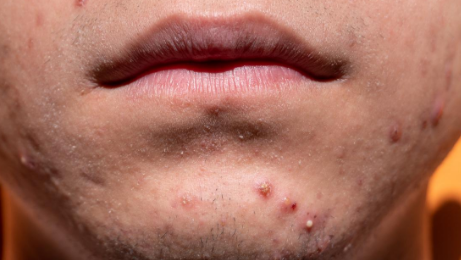 여드름 난 남성의 턱