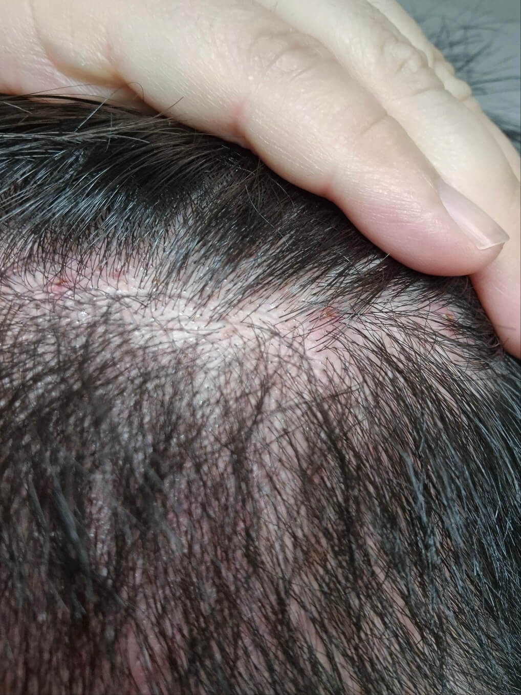 지루성 두피염으로 인한 피부 손상