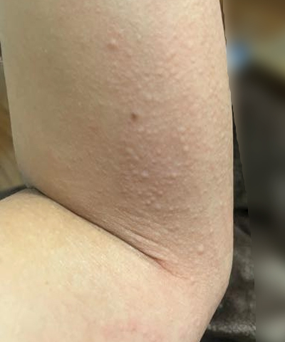 팔 좁쌀 두드러기