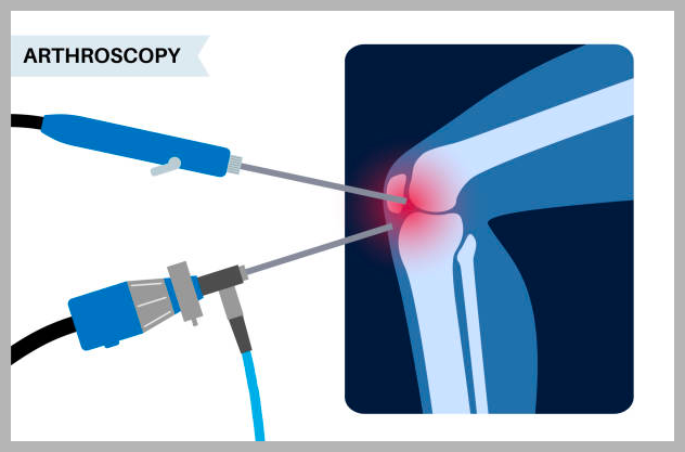 연골연화증 치료 운동 방법