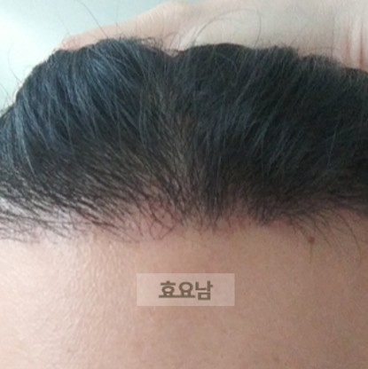 M자 모발이식-2주차-상태-2