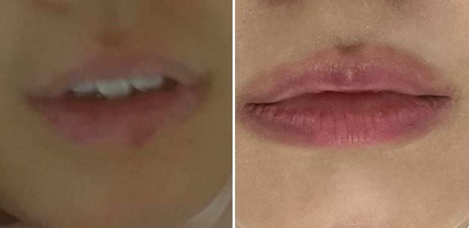 인비절라인 효과