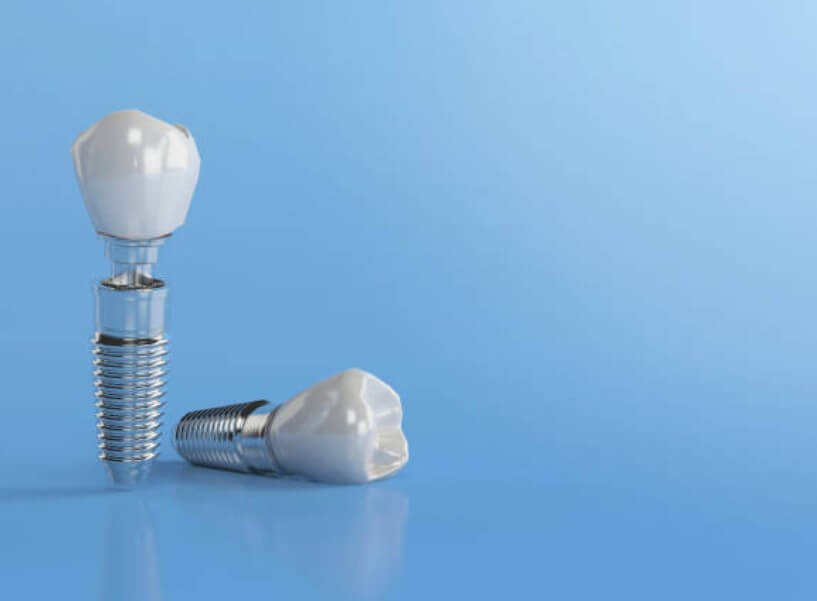 임플란트 시술과정