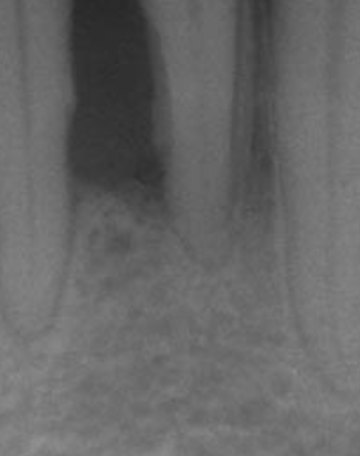 치주염 방사선사진