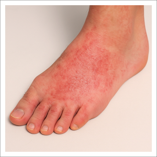 접촉성 피부염 증상_발등 발현