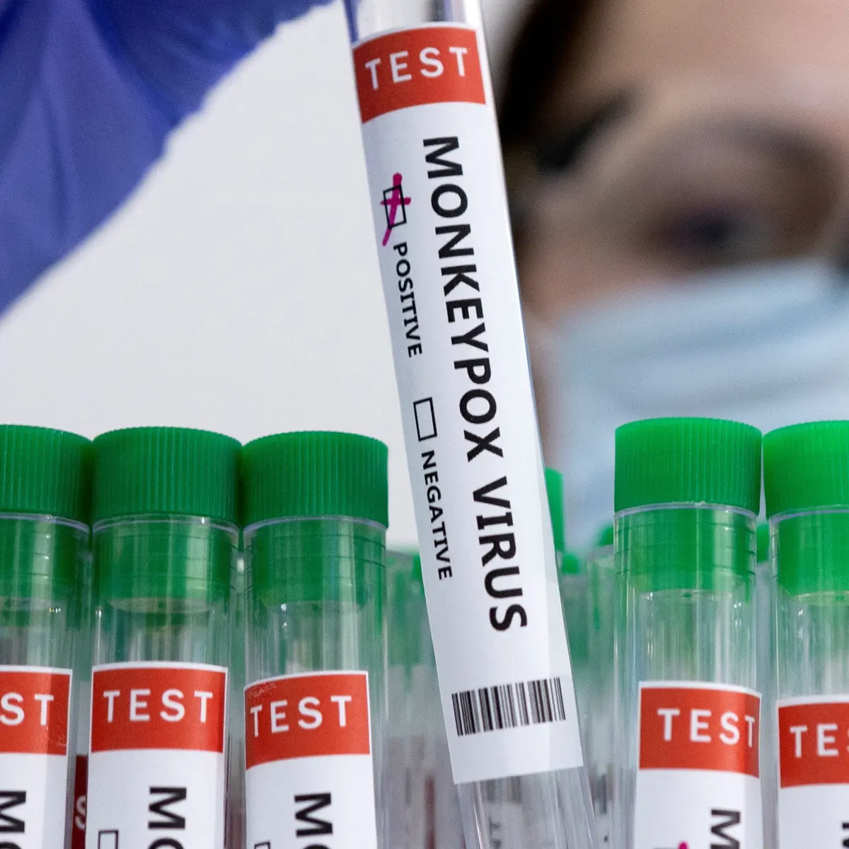 원숭이 두창 검사