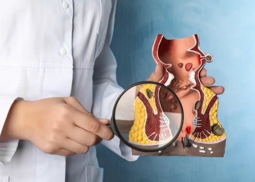 항문에서 피가나는 이유