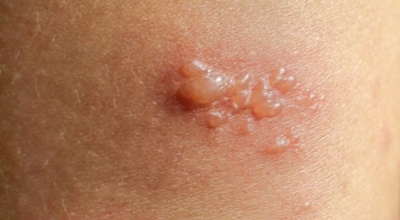 대상포진이미지