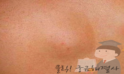 사타구니 멍울