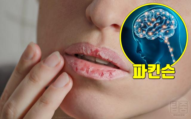 입냄새 심한 이유 입냄새 원인 질환 입마름