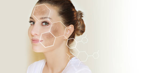 기미,검버섯 사진