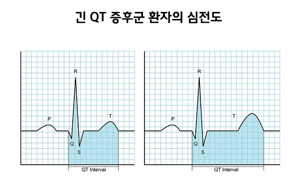 QT 연장증후군(긴QT)