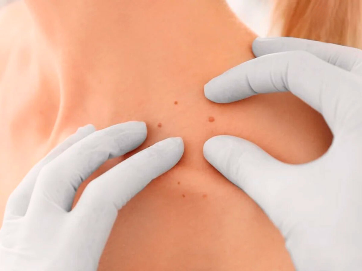 효과적인 쥐젖제거