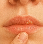 입술에 물집이 생기는 이유