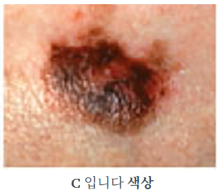 흑색종