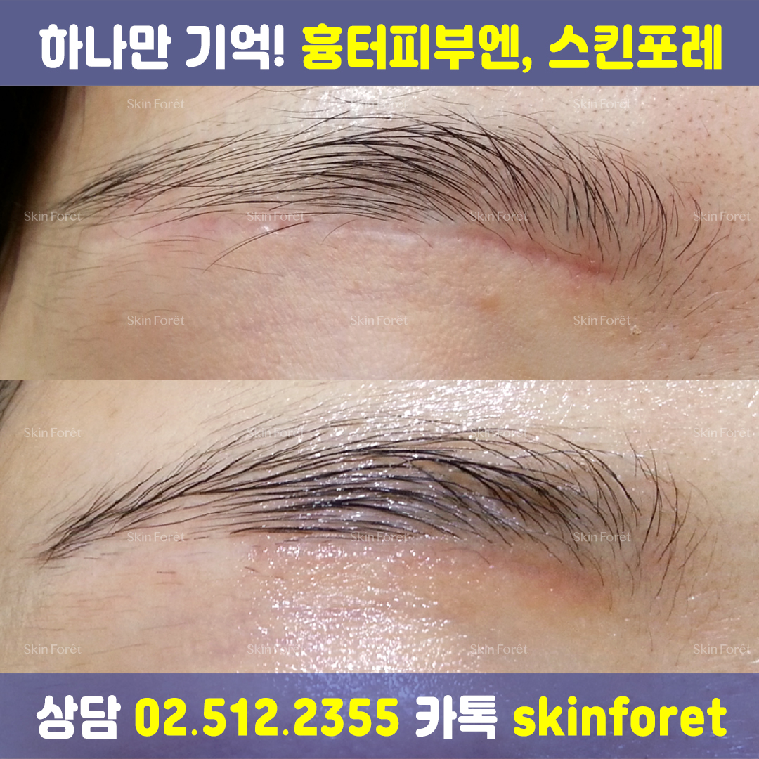 흉터 제거 전후, 강남 흉터 전문 케어 사례