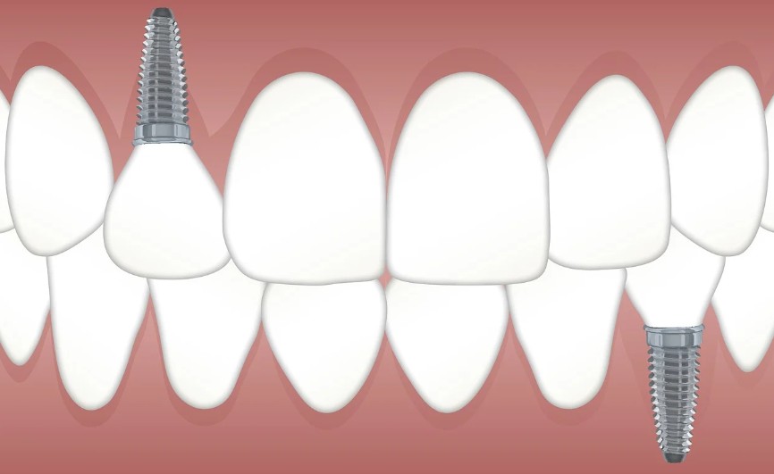 경기도-광주시-임플란트-치과-가격-비용-싼-곳,저렴한-곳,잘하는-곳,유명한-곳-BEST20-추천4