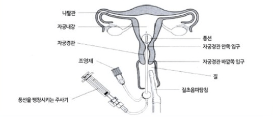 나팔관 조영 초음파 시술 방법