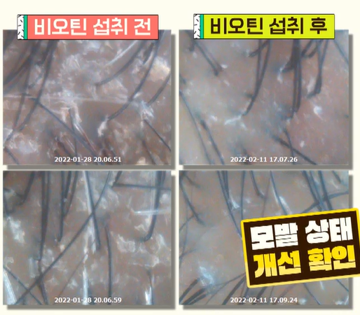 비오틴 효능