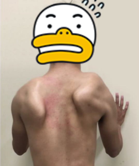 winging scapular