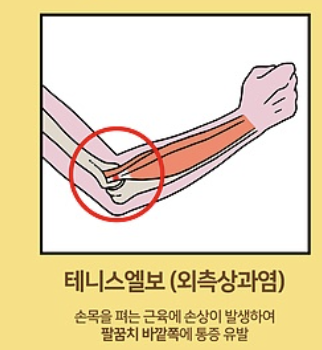 팔꿈치 통증 3