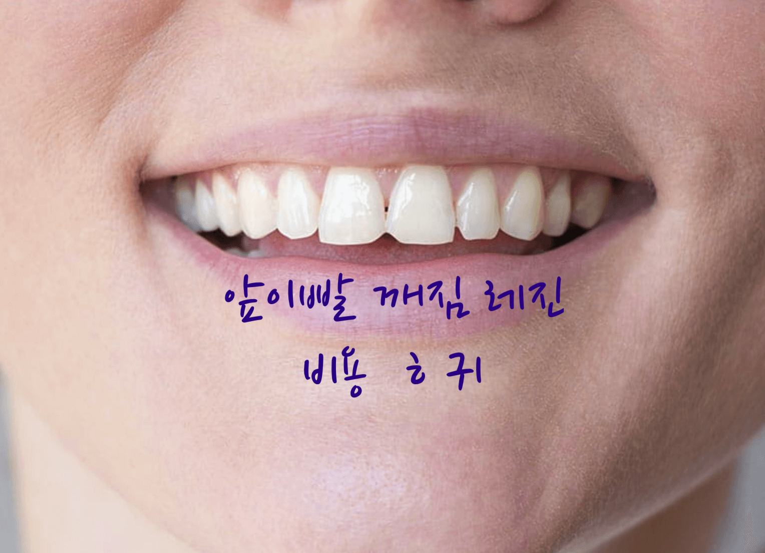 앞이빨 깨짐 레진