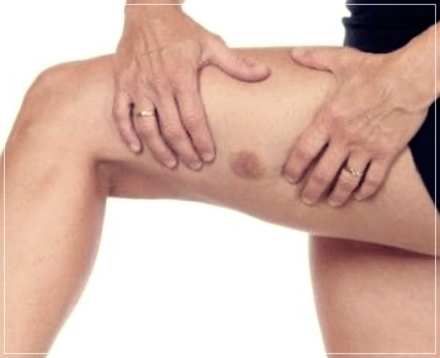 지방종 제거 수술: 원인, 절차, 비용