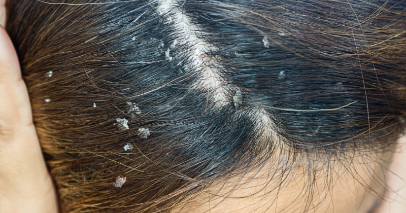 지루성피부염 두피