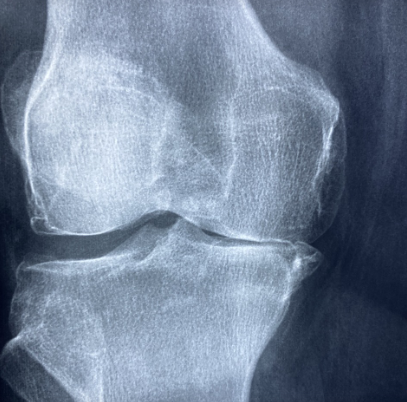 무릎 통증, 연골 손상, 초기 대응법 총 정리 (2025 ver.)