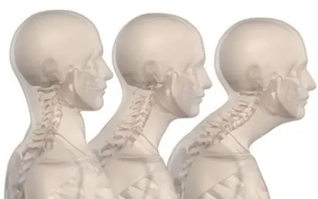 정상 경추 구조에서 거북목 증후군 및 일자목으로 진행되는 목 뼈 배열의 단계별 변형 과정 비교 그래픽