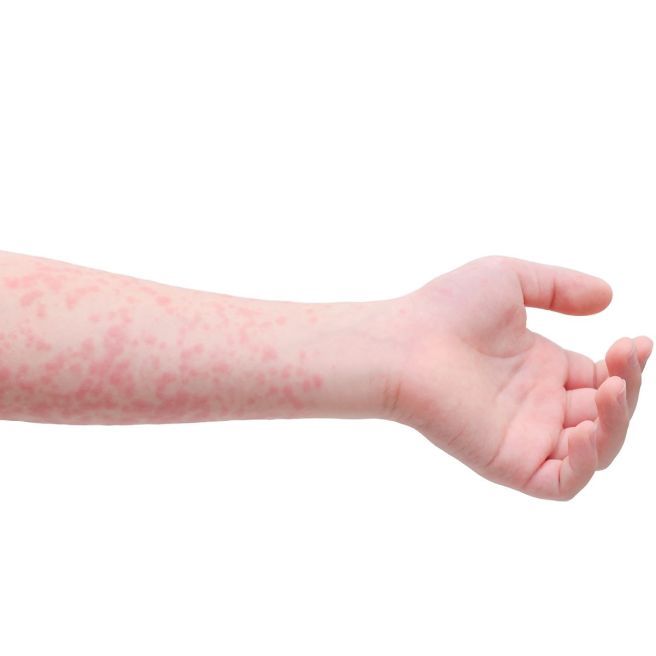 자반증 치료방법