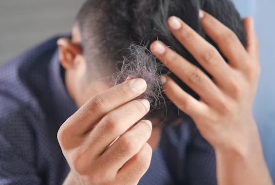 남자가-탈모된-부분을-잡아서-보여주고-있다