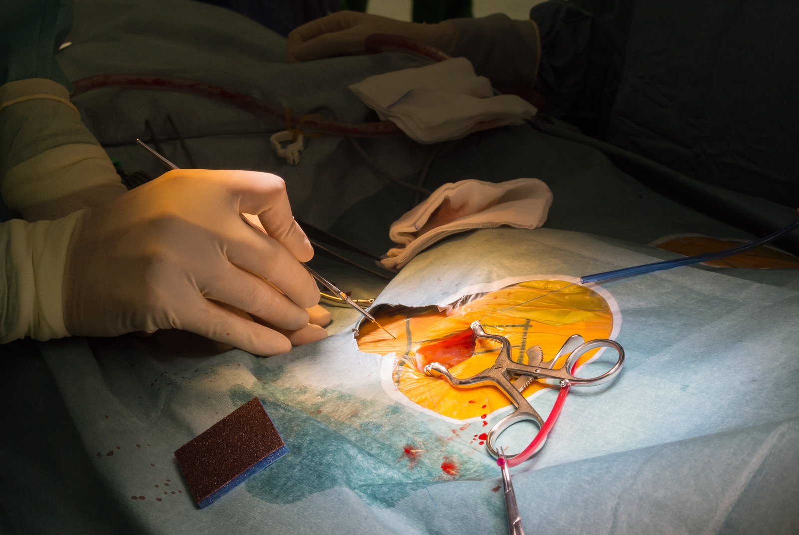 경피적 신장 결석 제거술 (PCNL) &ndash; 20mm 이상 큰 결석 치료