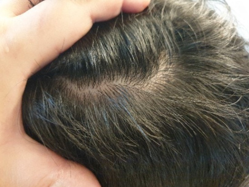 지루성 두피 염 샴푸