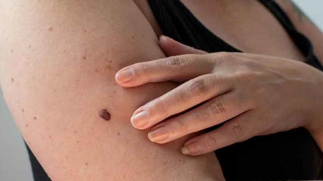 피부암 종류별 초기증상 10가지 및 흑색종 점모양 영상 피부암 수술사례