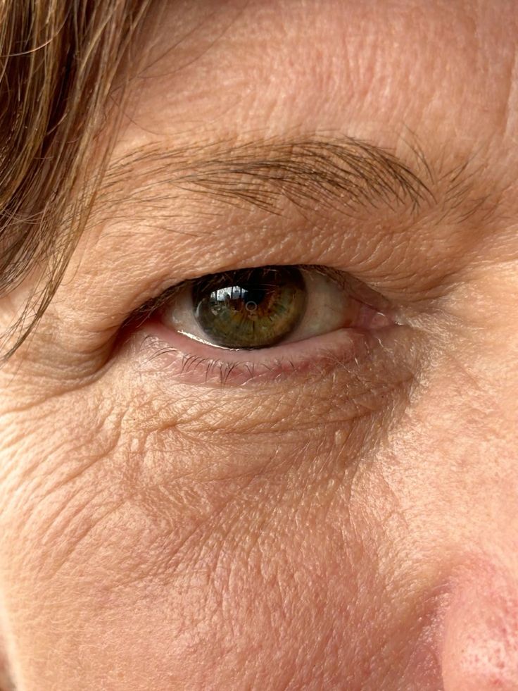 눈꺼풀이 처지는 이유, 질환? 노화?에 대해 설명하고 있습니다.