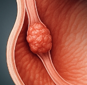식도암 초기증상