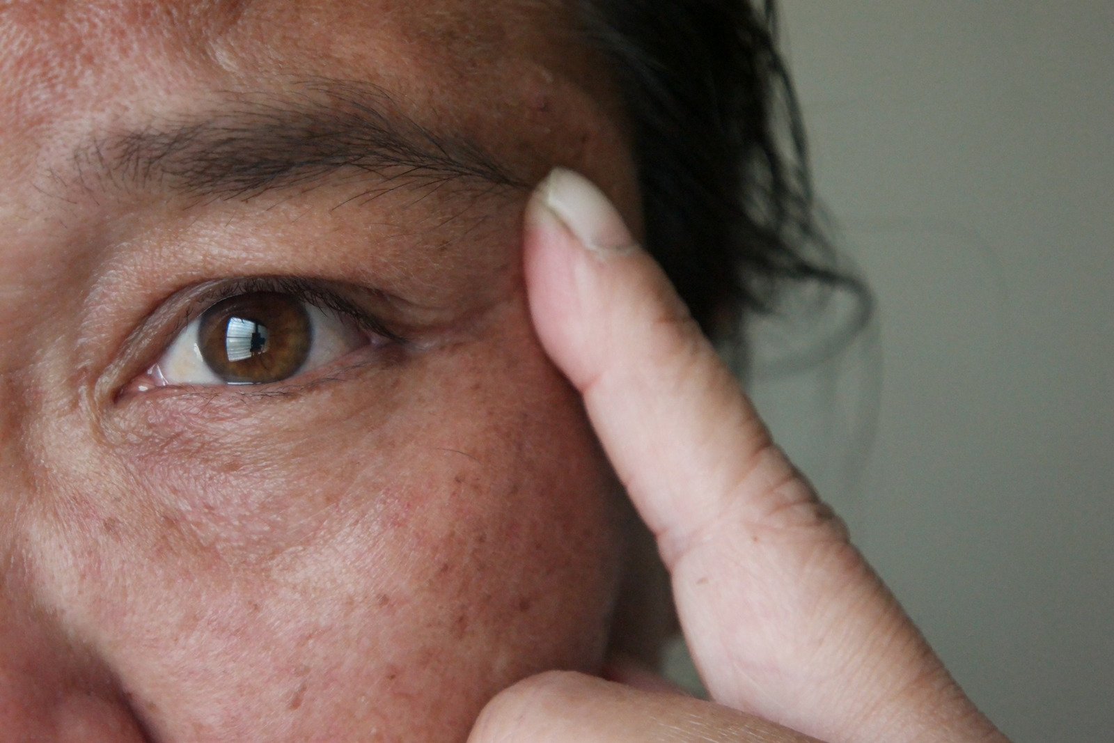 기미 치료 주사 – 기미 & 색소침착 완화를 위한 미백 주사 종류