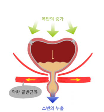 요실금_수술_후_회복기간_부작용_비용_보험적용여부