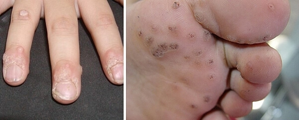 편평사마귀와-쥐젖의-차이와-전염성과-제거방법과-제거후-관리방법에-대해서