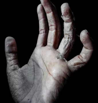 건조증 증상 피부 안구 코 구강 원인 치료법