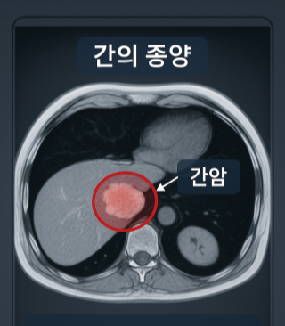 간암 병변이 표시된 MRI 의료 이미지