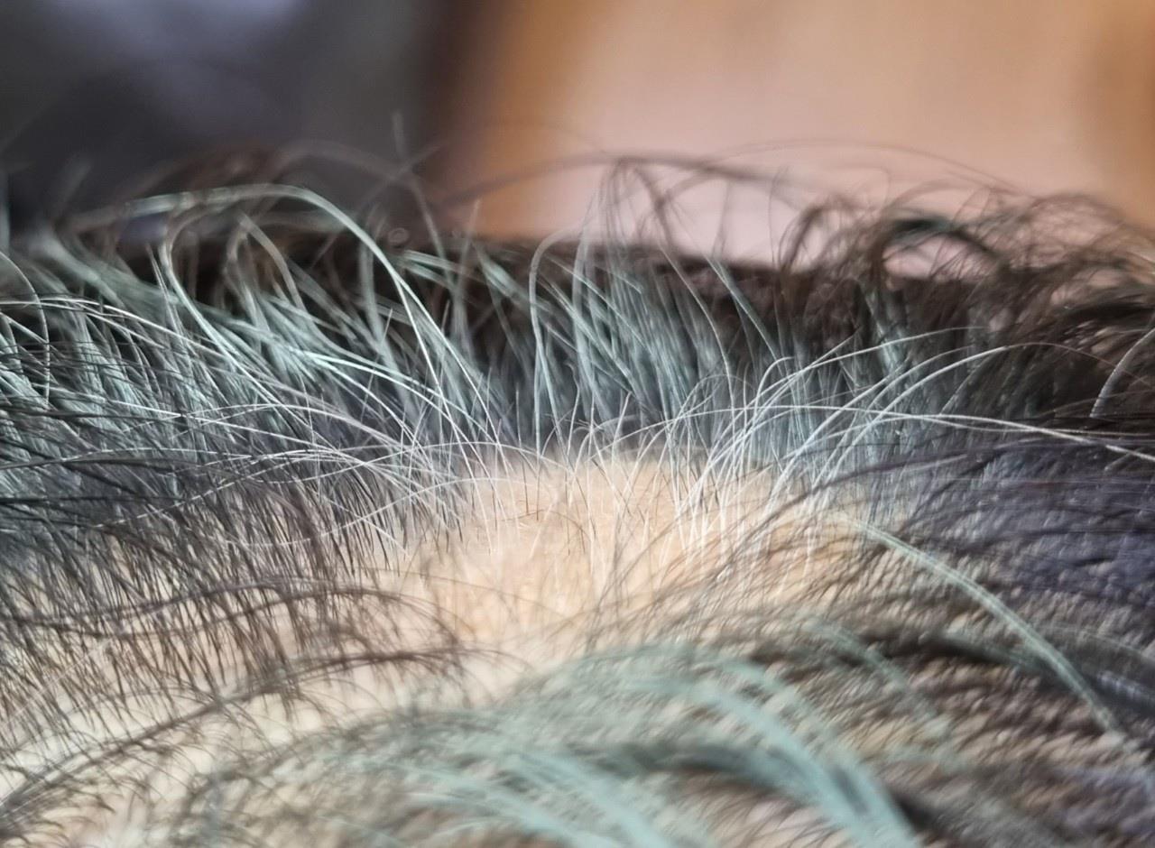 원형탈모 오일 사용 후기 2 이미지