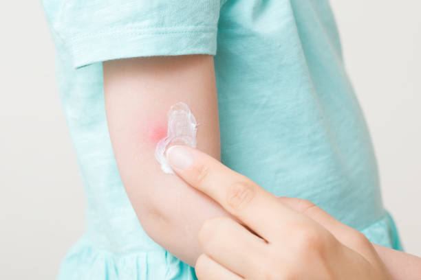 아이유 모기알레르기 스키터증후군 모기기피제 항히스타민제 스테로이드크림