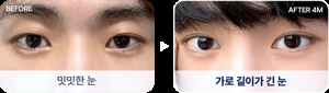 남자 눈매 교정술