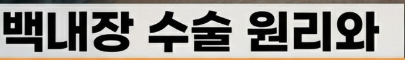 백내장 수술후 시력회복 기간
