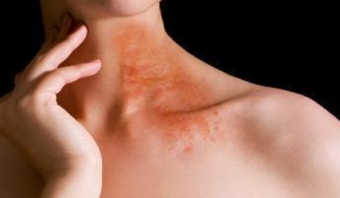 대상포진 초기증상