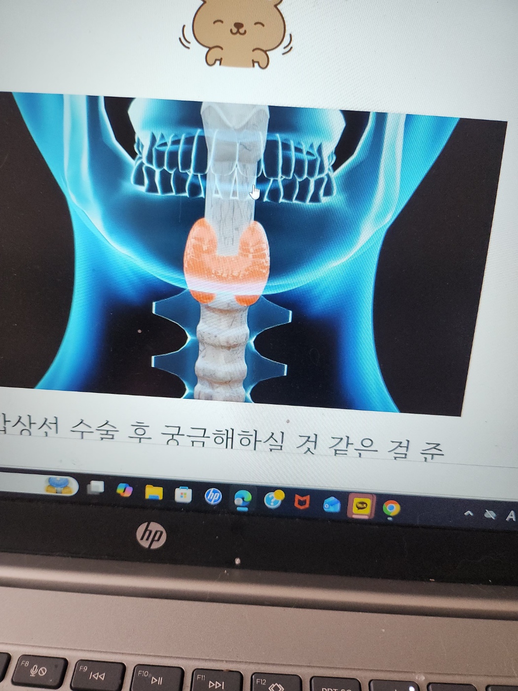 갑상선 사진